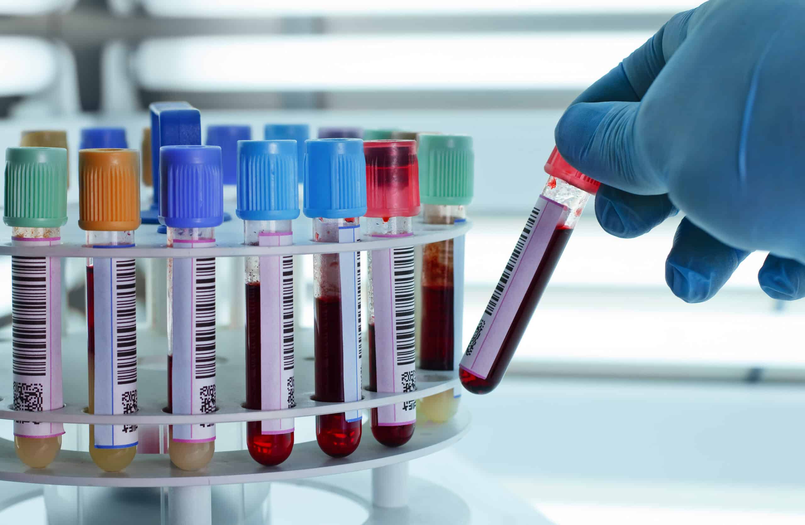 Update in Internal Medicine: blood tubes