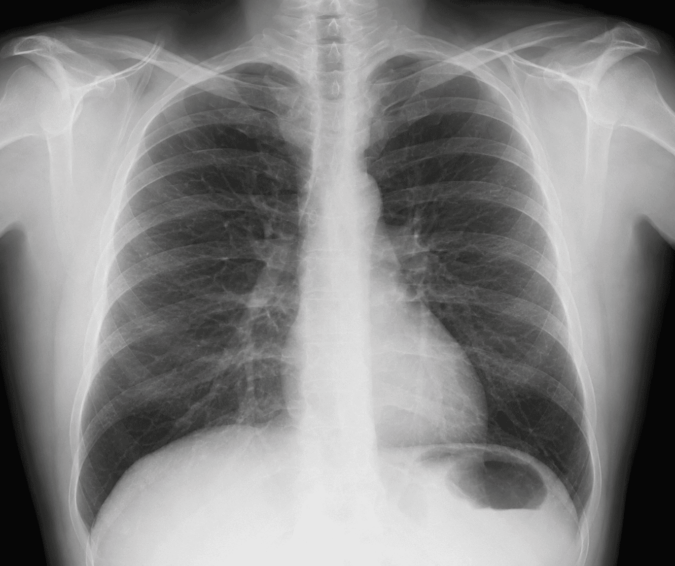 Chest x-ray